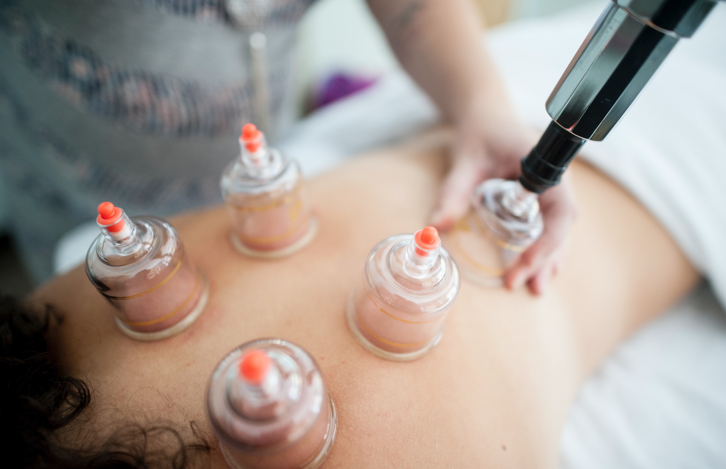 Cupping Treatments